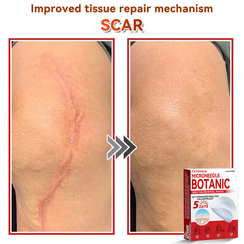 𝐅𝐀𝐓𝐎𝐍𝐆® 𝐌𝐢𝐜𝐫𝐨𝐍𝐞𝐞𝐝𝐥𝐞 𝐁𝐨𝐭𝐚𝐧𝐢𝐜 𝐒𝐤𝐢𝐧 𝐓𝐚𝐠 𝐑𝐞𝐦𝐨𝐯𝐚𝐥 𝐏𝐚𝐭𝐜𝐡 - Made in the U.K 🍁💖