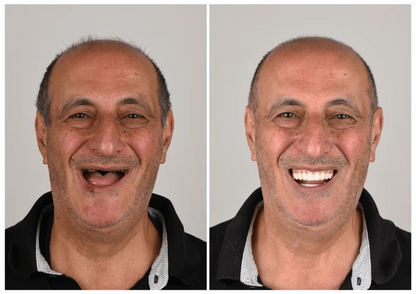 🦷 Jasseem® Custom-Fit Functional Dentures 😁 Smile with Confidence🍁💖