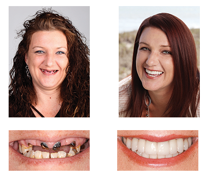 🦷 Jasseem® Custom-Fit Functional Dentures 😁 Smile with Confidence🍁💖