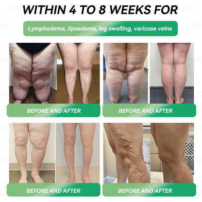 𝑉𝑠𝑜𝑥𝑎® 𝐺𝐿𝑃-1 𝑀𝑖𝑐𝑟𝑜𝑐𝑎𝑝𝑠𝑢𝑙𝑒 𝐵𝑢𝑟𝑠𝑡 𝑃𝑎𝑡𝑐ℎ - 👨‍⚕️