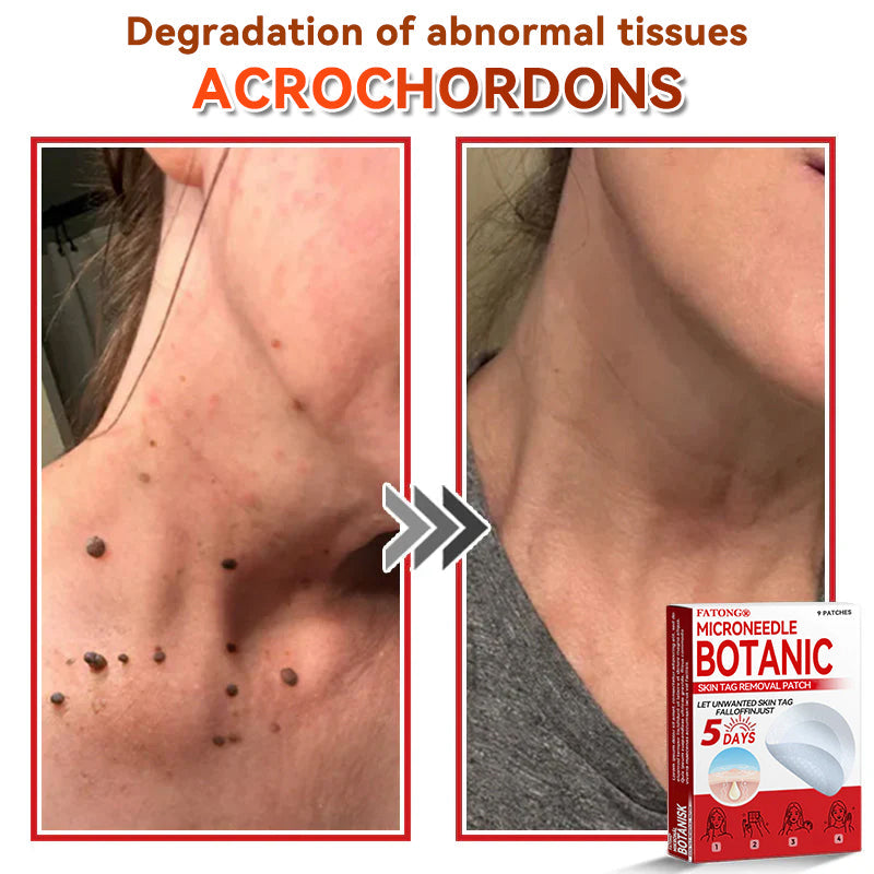 𝐅𝐀𝐓𝐎𝐍𝐆® 𝐌𝐢𝐜𝐫𝐨𝐍𝐞𝐞𝐝𝐥𝐞 𝐁𝐨𝐭𝐚𝐧𝐢𝐜 𝐒𝐤𝐢𝐧 𝐓𝐚𝐠 𝐑𝐞𝐦𝐨𝐯𝐚𝐥 𝐏𝐚𝐭𝐜𝐡 - Made in the U.K 🍁💖