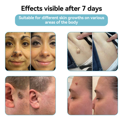[Visible results in just 7 days]💧𝐉𝐚𝐬𝐬𝐞𝐞𝐦® Non-invasive Mole and Wart Removal Laser Pen (Quick and painless removal of warts, moles, age spots and skin tags - without any side effects)🫐