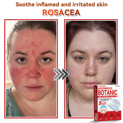 𝐅𝐀𝐓𝐎𝐍𝐆® 𝐌𝐢𝐜𝐫𝐨𝐍𝐞𝐞𝐝𝐥𝐞 𝐁𝐨𝐭𝐚𝐧𝐢𝐜 𝐒𝐤𝐢𝐧 𝐓𝐚𝐠 𝐑𝐞𝐦𝐨𝐯𝐚𝐥 𝐏𝐚𝐭𝐜𝐡 - Made in the U.K 🍁💖