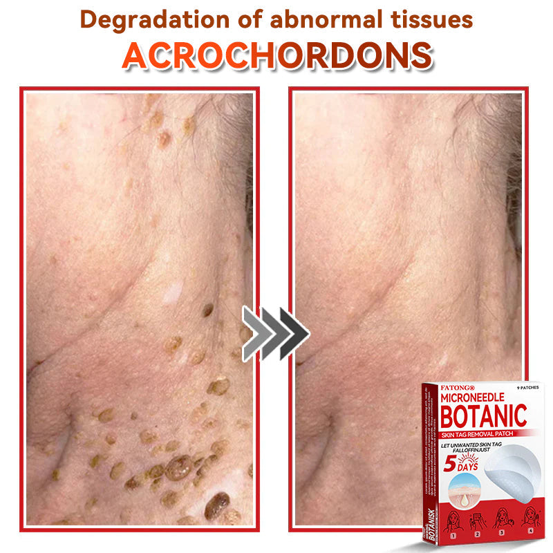 𝐅𝐀𝐓𝐎𝐍𝐆® 𝐌𝐢𝐜𝐫𝐨𝐍𝐞𝐞𝐝𝐥𝐞 𝐁𝐨𝐭𝐚𝐧𝐢𝐜 𝐒𝐤𝐢𝐧 𝐓𝐚𝐠 𝐑𝐞𝐦𝐨𝐯𝐚𝐥 𝐏𝐚𝐭𝐜𝐡 - Made in the U.K 🍁💖