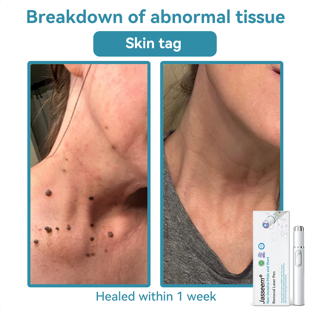 [Visible results in just 7 days]💧𝐉𝐚𝐬𝐬𝐞𝐞𝐦® Non-invasive Mole and Wart Removal Laser Pen (Quick and painless removal of warts, moles, age spots and skin tags - without any side effects)🫐
