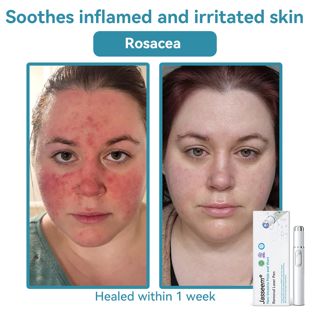 [Visible results in just 7 days]💧𝐉𝐚𝐬𝐬𝐞𝐞𝐦® Non-invasive Mole and Wart Removal Laser Pen (Quick and painless removal of warts, moles, age spots and skin tags - without any side effects)🫐