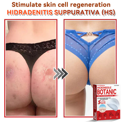 𝐅𝐀𝐓𝐎𝐍𝐆® 𝐌𝐢𝐜𝐫𝐨𝐍𝐞𝐞𝐝𝐥𝐞 𝐁𝐨𝐭𝐚𝐧𝐢𝐜 𝐒𝐤𝐢𝐧 𝐓𝐚𝐠 𝐑𝐞𝐦𝐨𝐯𝐚𝐥 𝐏𝐚𝐭𝐜𝐡 - Made in the U.K 🍁💖