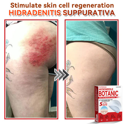 𝐅𝐀𝐓𝐎𝐍𝐆® 𝐌𝐢𝐜𝐫𝐨𝐍𝐞𝐞𝐝𝐥𝐞 𝐁𝐨𝐭𝐚𝐧𝐢𝐜 𝐒𝐤𝐢𝐧 𝐓𝐚𝐠 𝐑𝐞𝐦𝐨𝐯𝐚𝐥 𝐏𝐚𝐭𝐜𝐡 - Made in the U.K 🍁💖